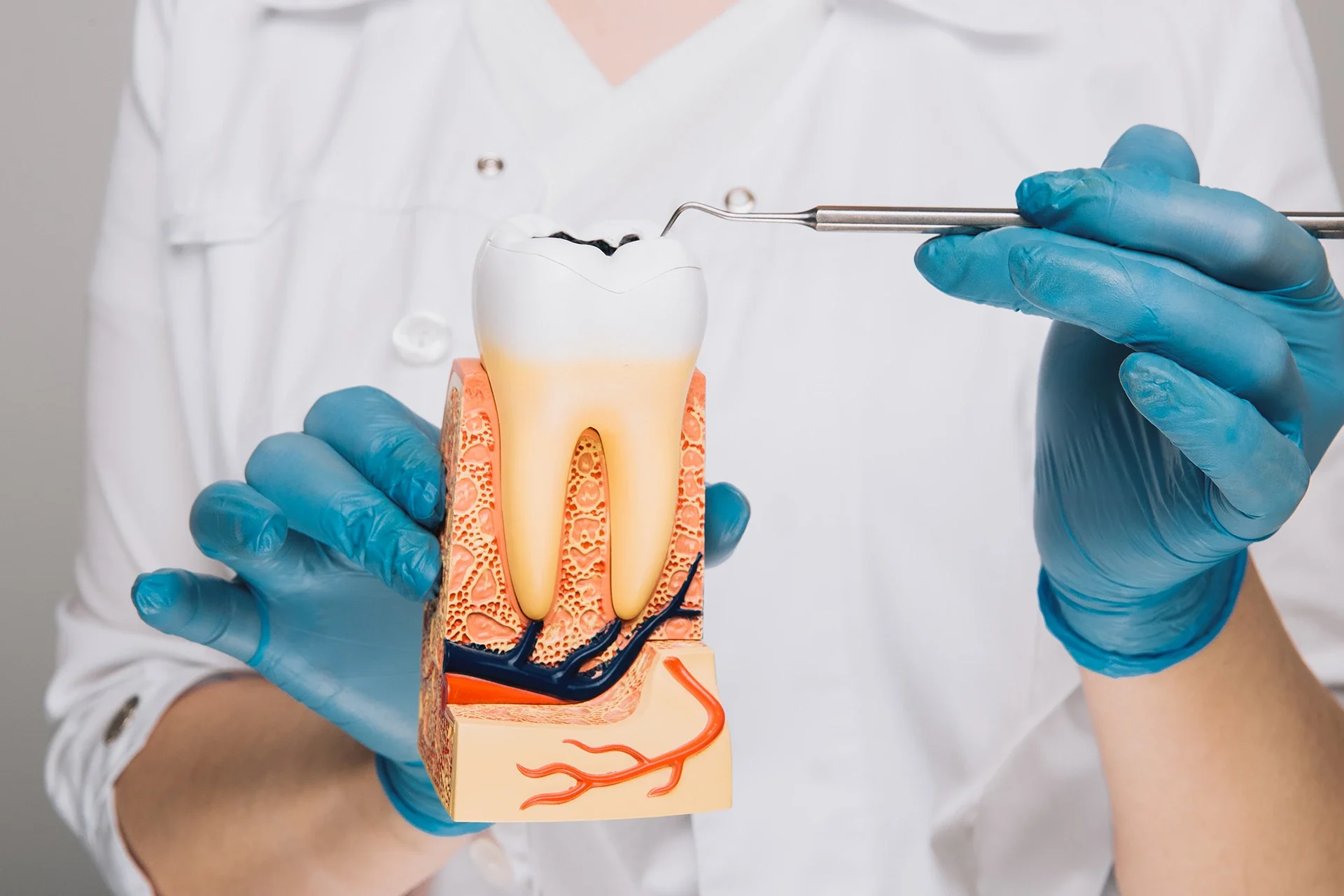 Danties modelis su parodyta šaknimi ir pažeista viršūne, naudojamas endodontinio gydymo paaiškinimui klinikoje